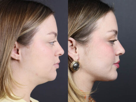 Necklift case #11064