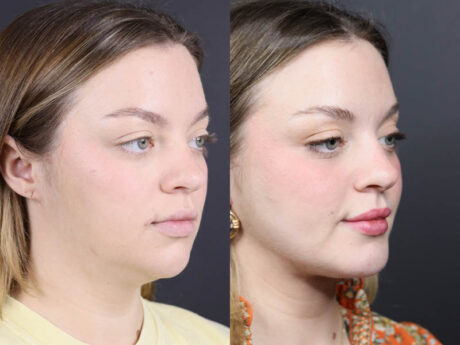 Necklift case #11064