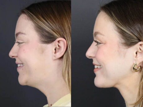 Necklift case #11064