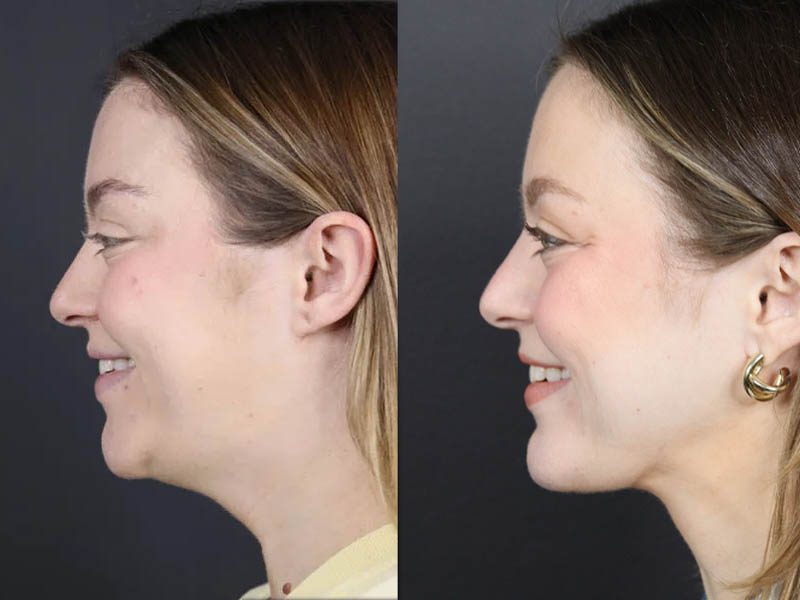 Necklift case #11064