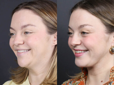 Necklift case #11064