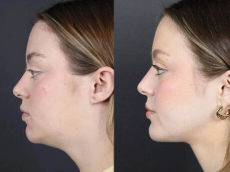 Necklift case #11064