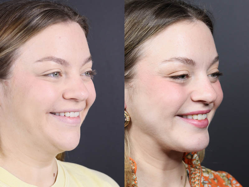 Necklift case #11064