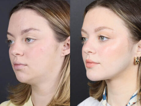 Necklift case #11064