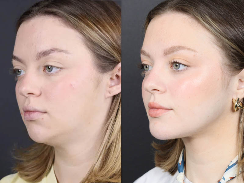 Necklift case #11064