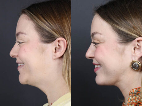 Necklift case #11064