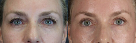 Blepharoplasty case #11083