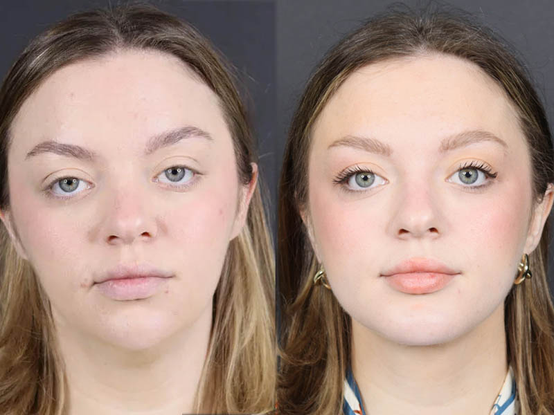 Necklift case #11064