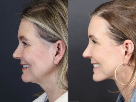 C02 Laser case #11033