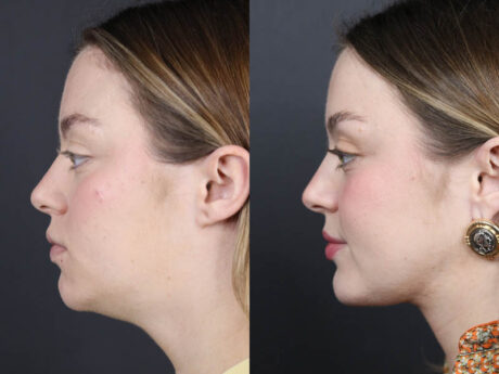 Necklift case #11064