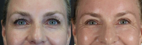Blepharoplasty case #11083