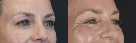 Blepharoplasty case #11083