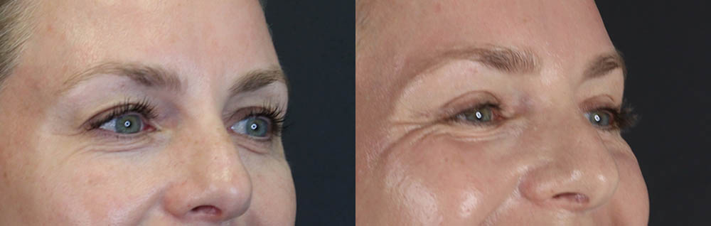 Blepharoplasty case #11083