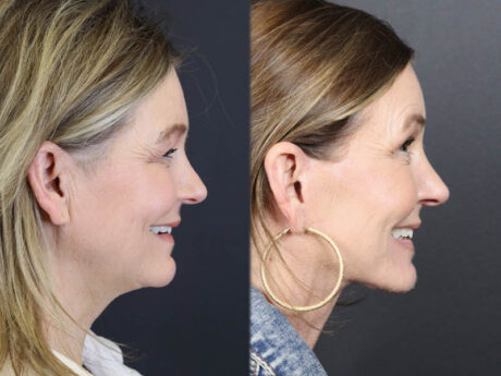 C02 Laser case #11033