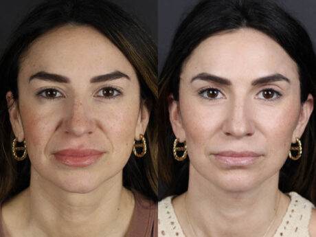 Facelift case #11023