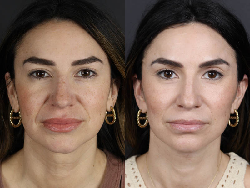 Facelift case #11023