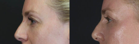 Blepharoplasty case #11083