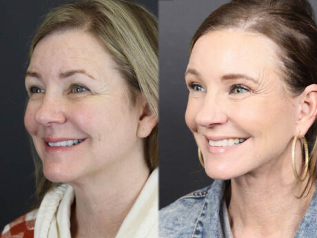 C02 Laser case #11033