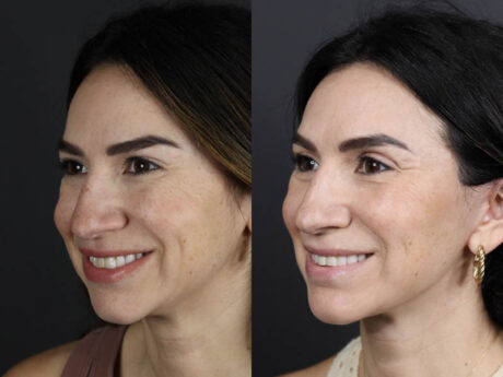 Facelift case #11023