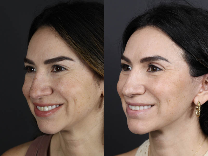 Facelift case #11023