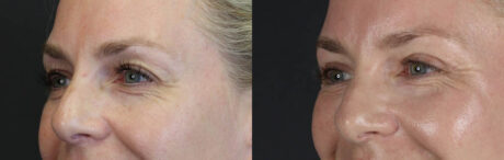 Blepharoplasty case #11083