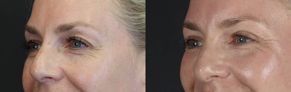 Blepharoplasty case #11083