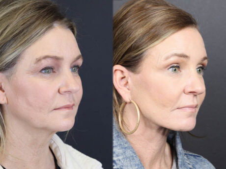 C02 Laser case #11033