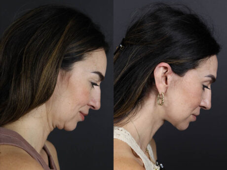 Facelift case #11023