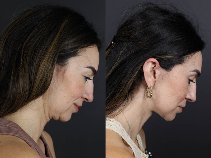 Facelift case #11023