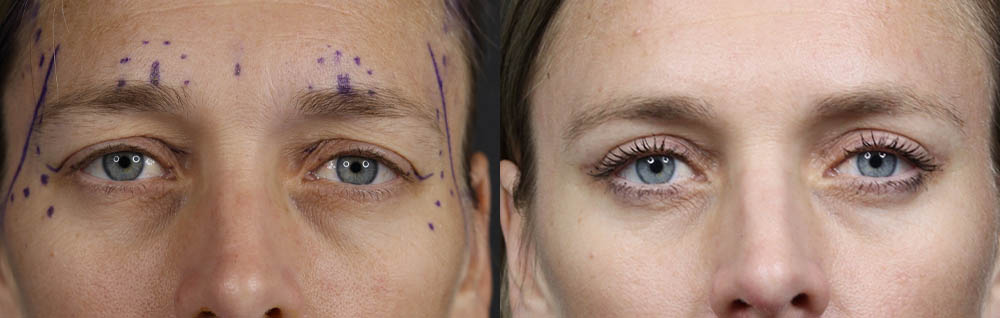 Blepharoplasty case #11090