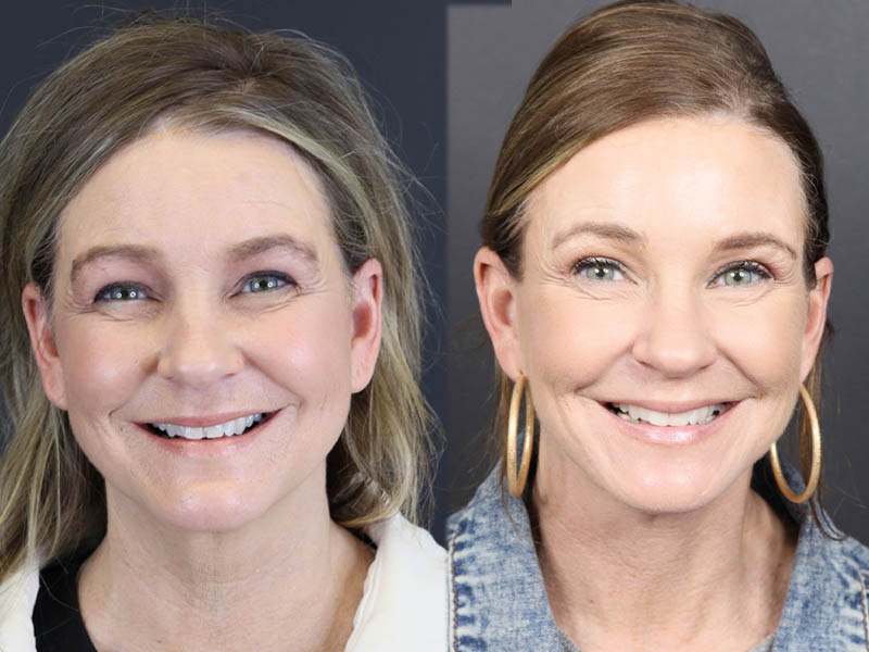 C02 Laser case #11033