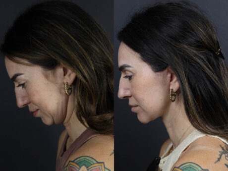 Facelift case #11023