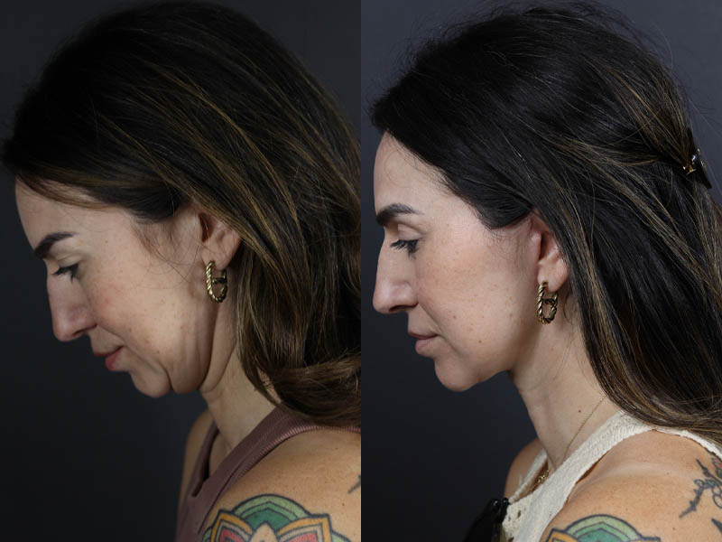 Facelift case #11023