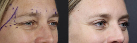 Blepharoplasty case #11090