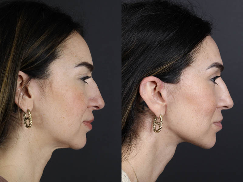 Facelift case #11023