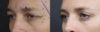 Blepharoplasty case #11090 slider thumbnail