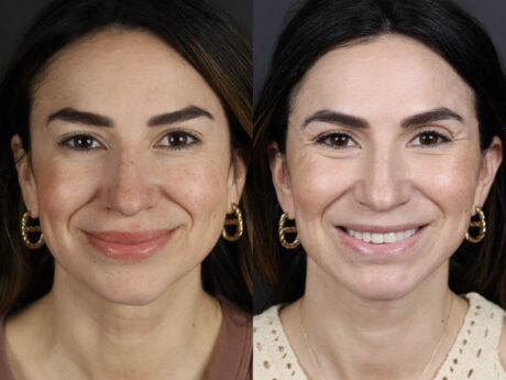 Facelift case #11023