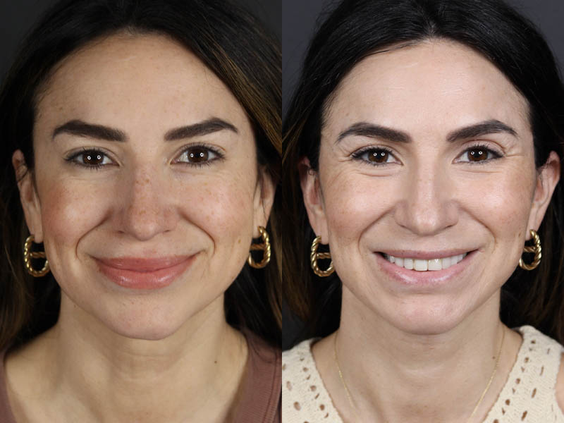 Facelift case #11023