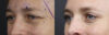 Blepharoplasty case #11090 slider thumbnail