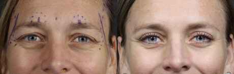 Blepharoplasty case #11090