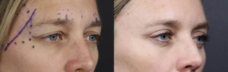 Blepharoplasty case #11090