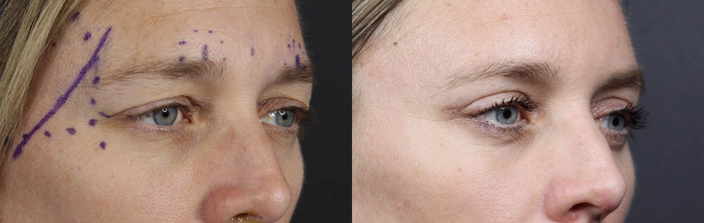 Blepharoplasty case #11090