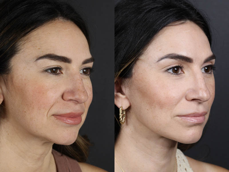 Facelift case #11023