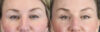 Blepharoplasty case #11097 slider thumbnail