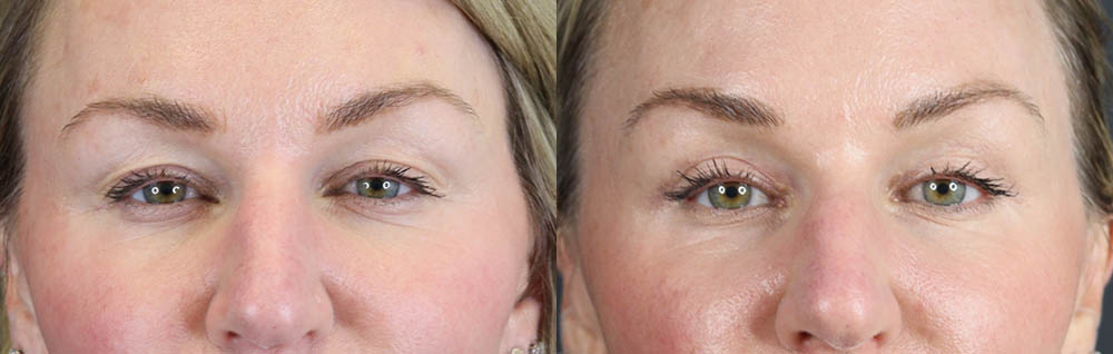 Blepharoplasty case #11097