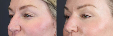 Blepharoplasty case #11097