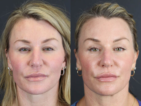 C02 Laser case #11016