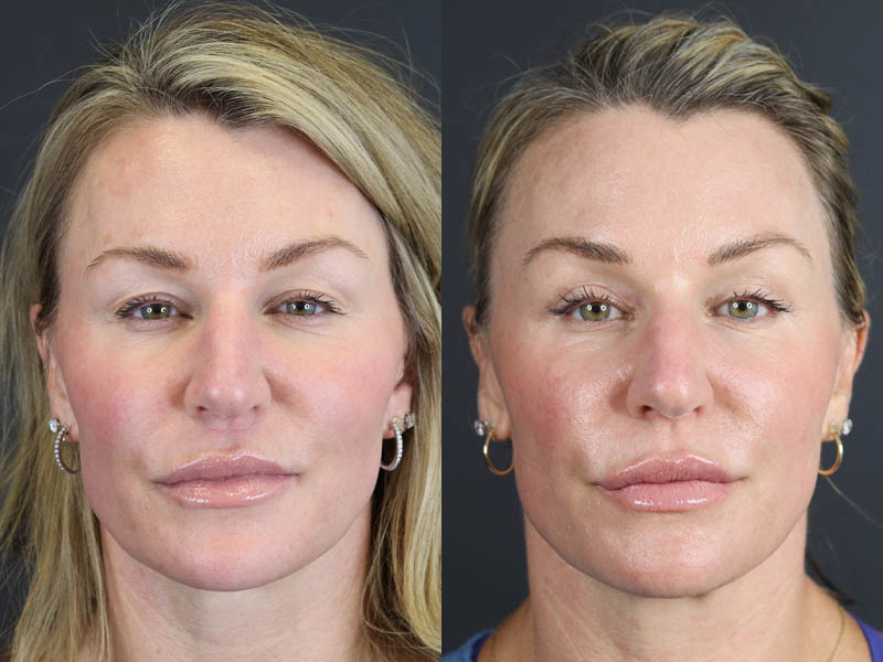 C02 Laser case #11016