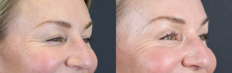 Blepharoplasty case #11097