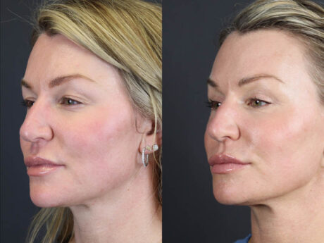 C02 Laser case #11016